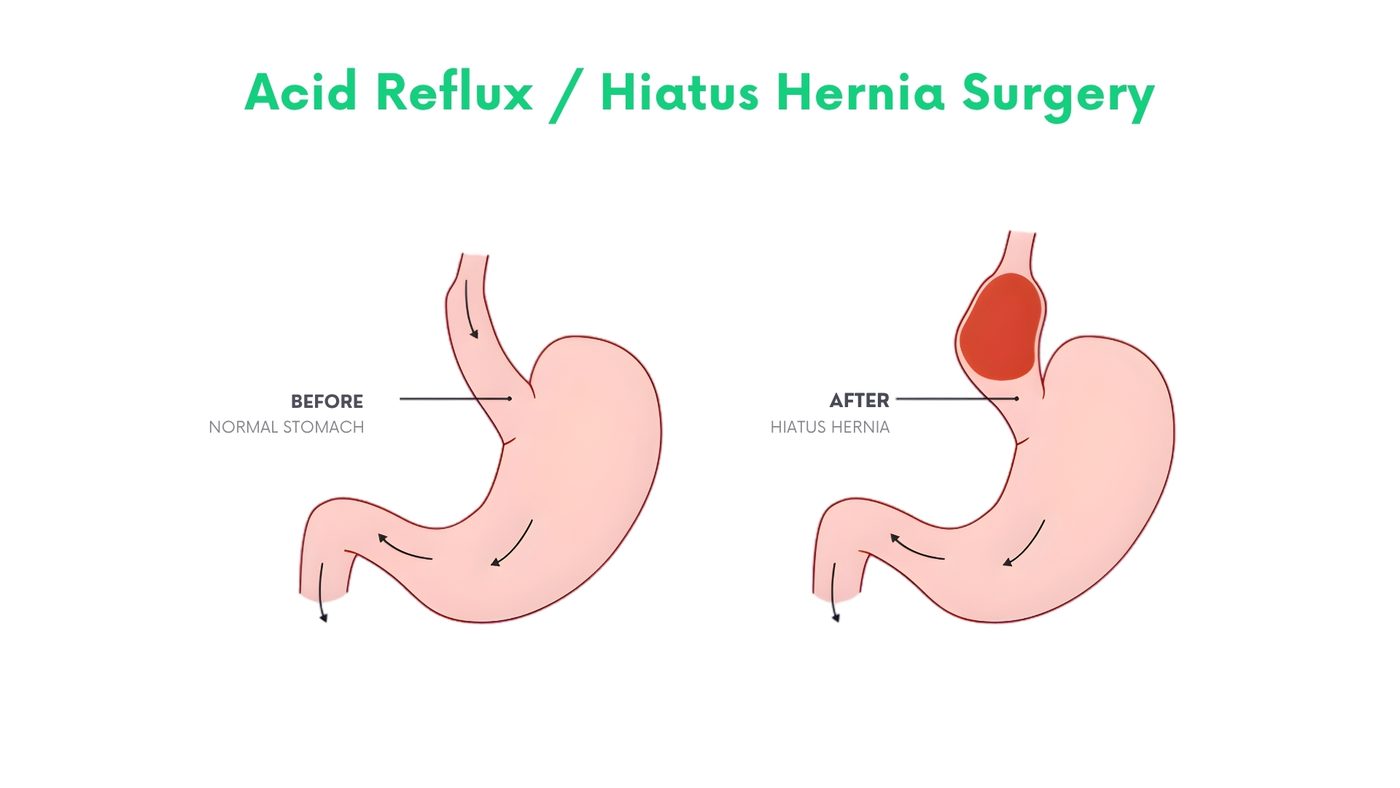 Acid Reflux / Hiatus Hernia Surgery by Dr. Shehryar Niazi