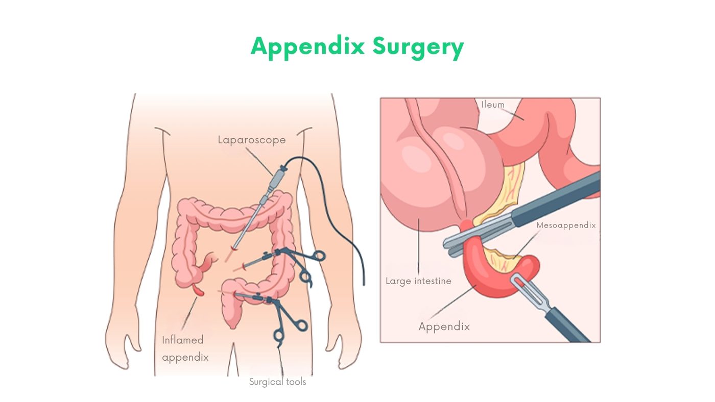 Appendix Surgery by Dr. Shehryar Niazi