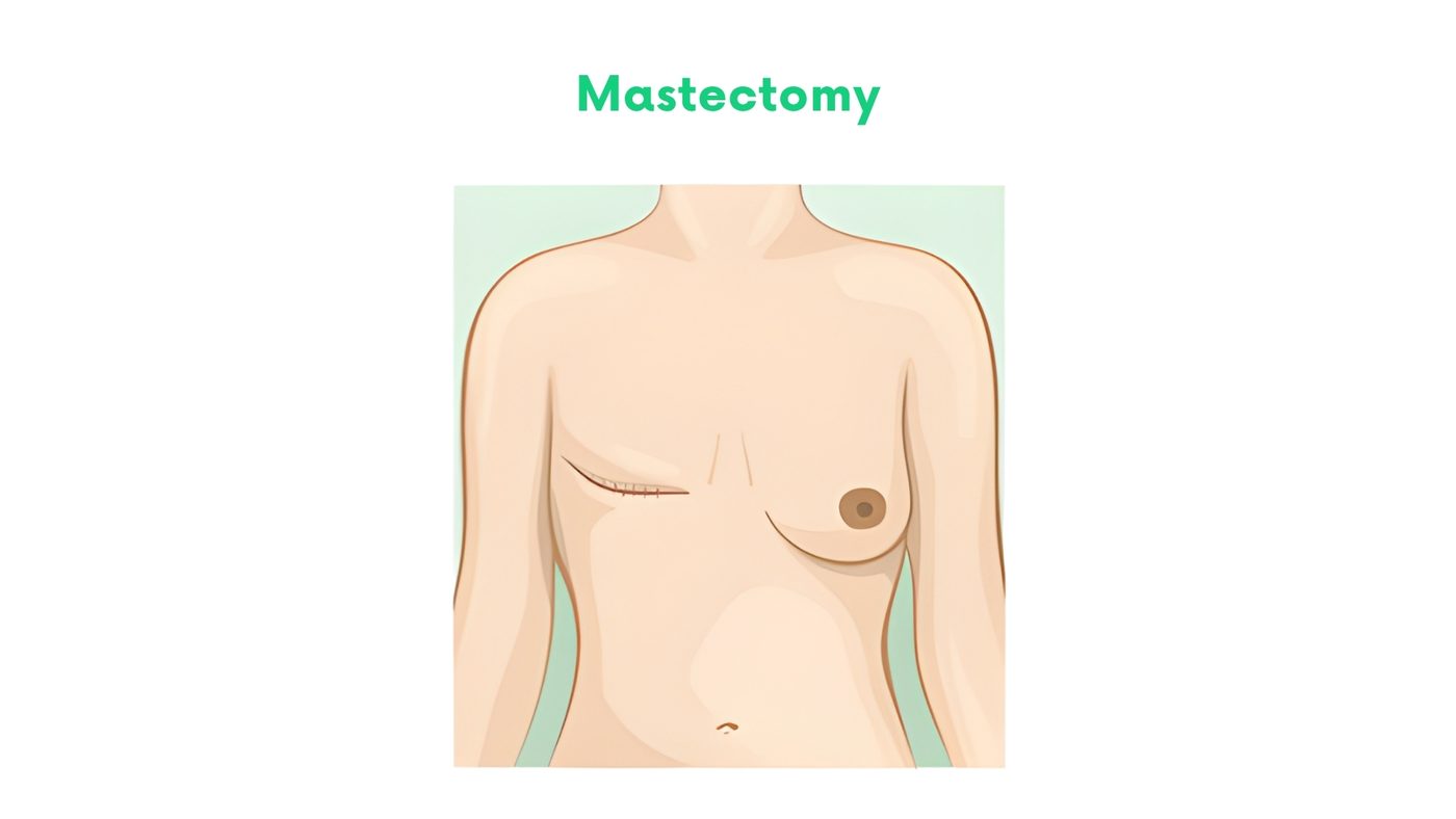Breast Surgery by Dr. Shehryar Niazi