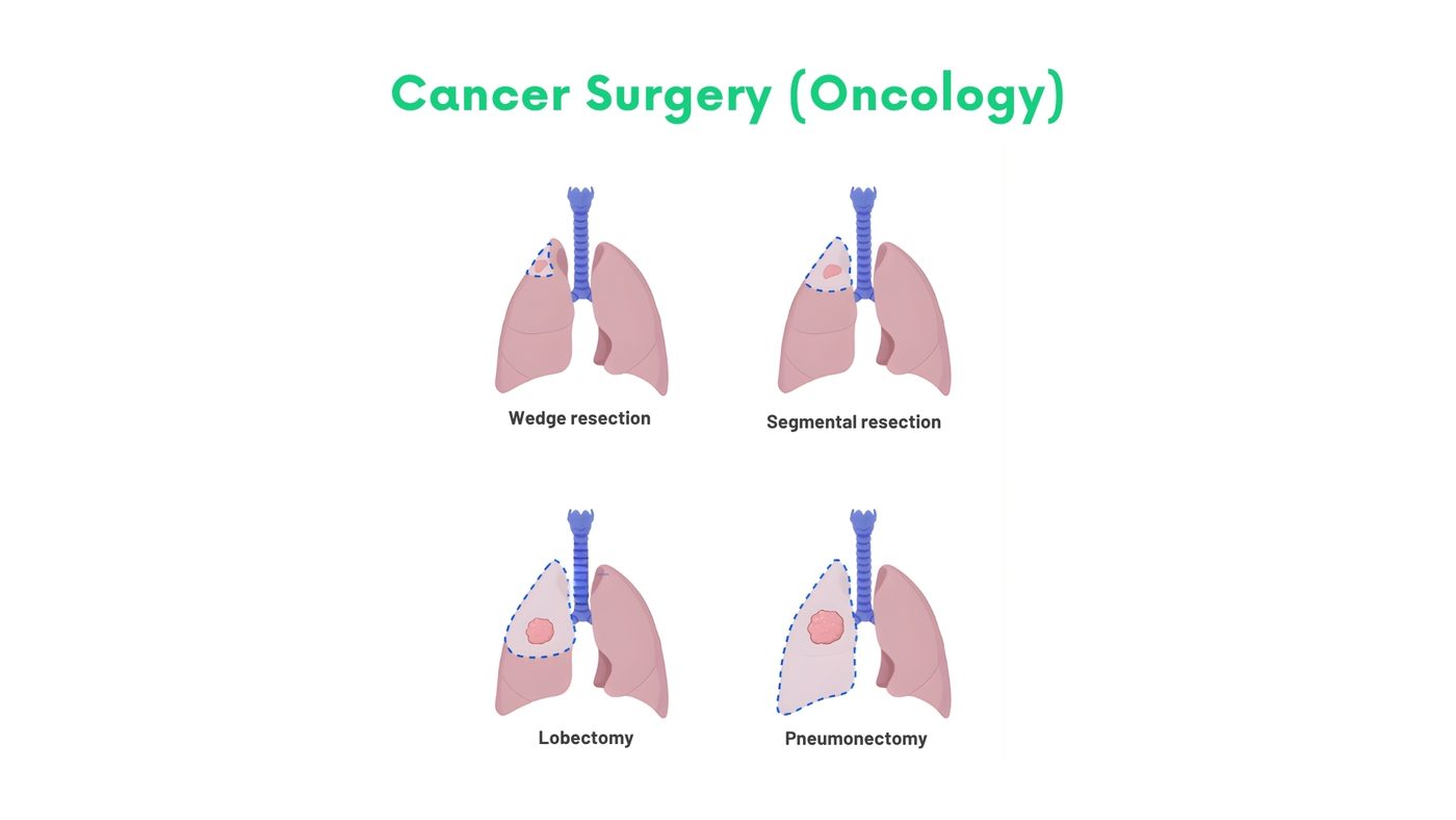 Cancer Surgery (Oncology) by Dr. Shehryar Niazi