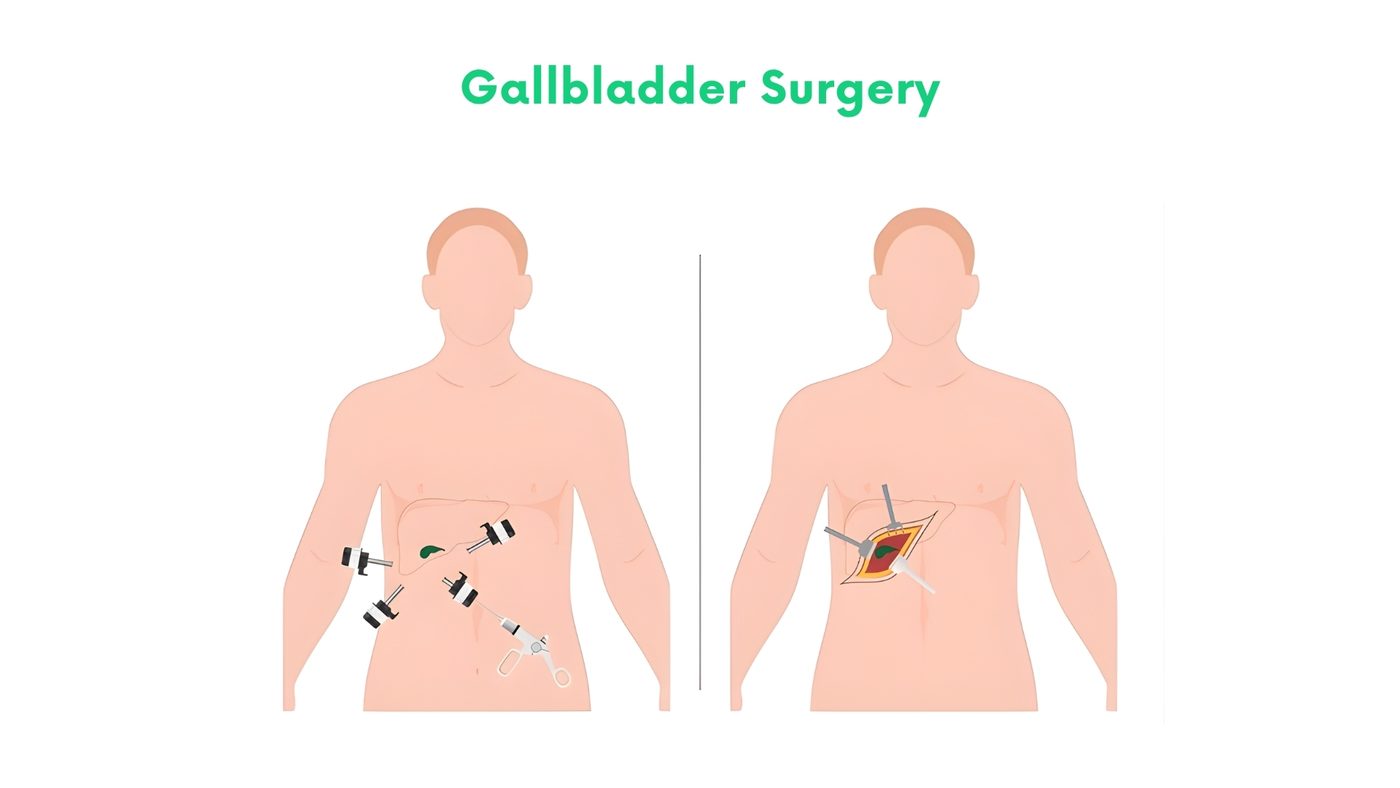 Gallbladder Surgery by Dr. Shehryar Niazi