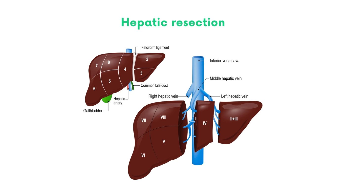 Hepatic resection (segmentectomy, lobectomy) by Dr. Shehryar Niazi