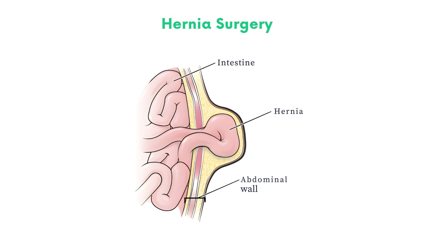 Hernia Surgery by Dr. Shehryar Niazi