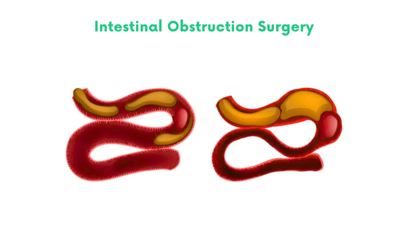Intestinal Obstruction Surgery by Dr. Shehryar Niazi