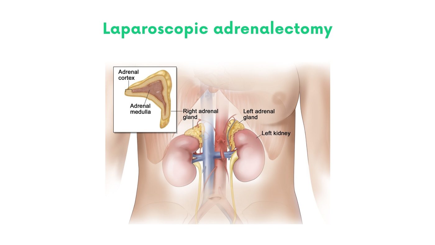 Laparoscopic adrenalectomy by Dr. Shehryar Niazi