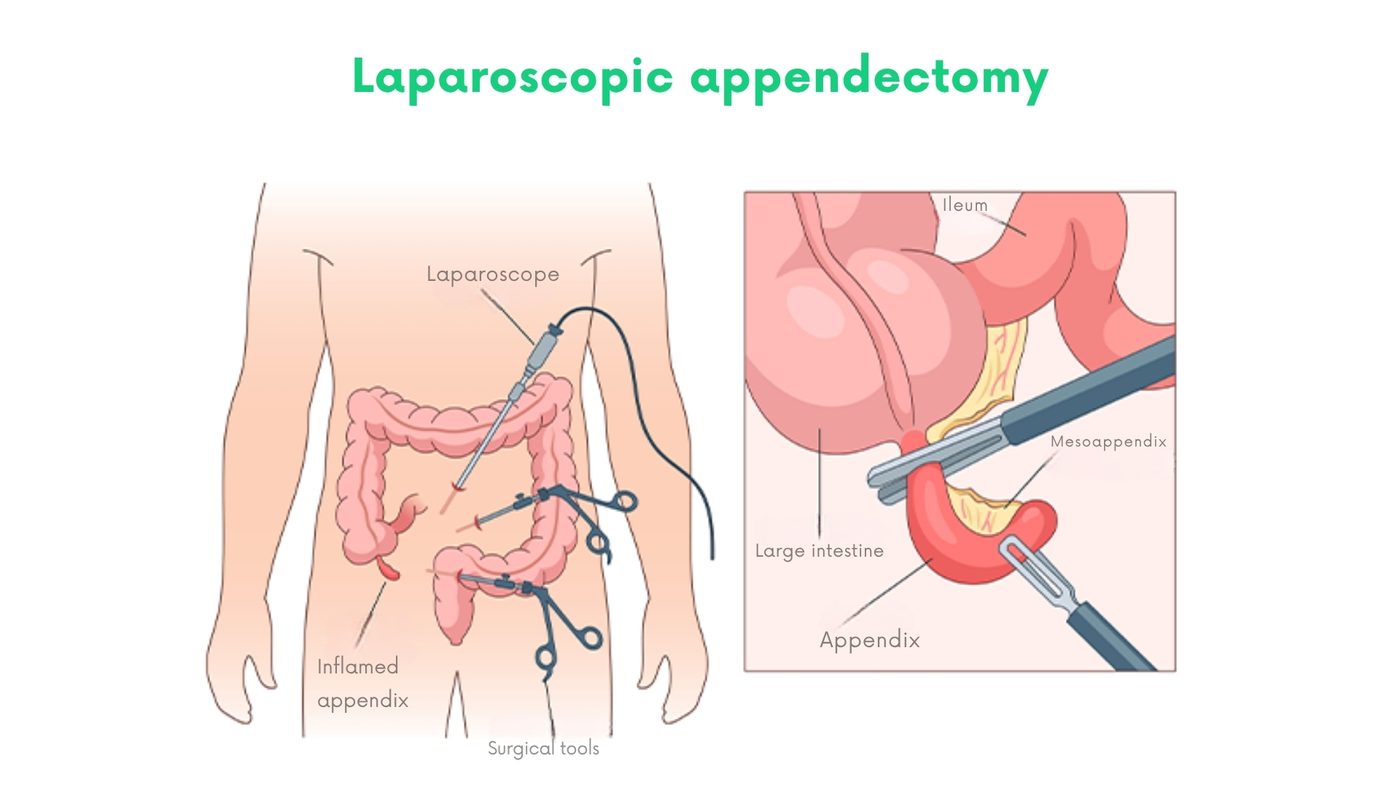Laparoscopic appendectomy by Dr. Shehryar Niazi