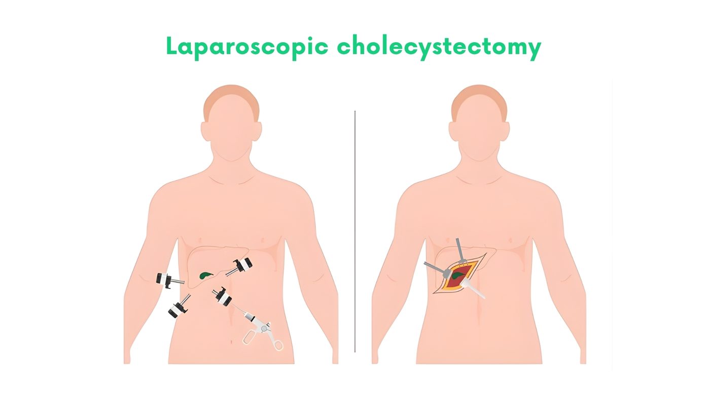 Laparoscopic cholecystectomy (gallbladder removal) by Dr. Shehryar Niazi