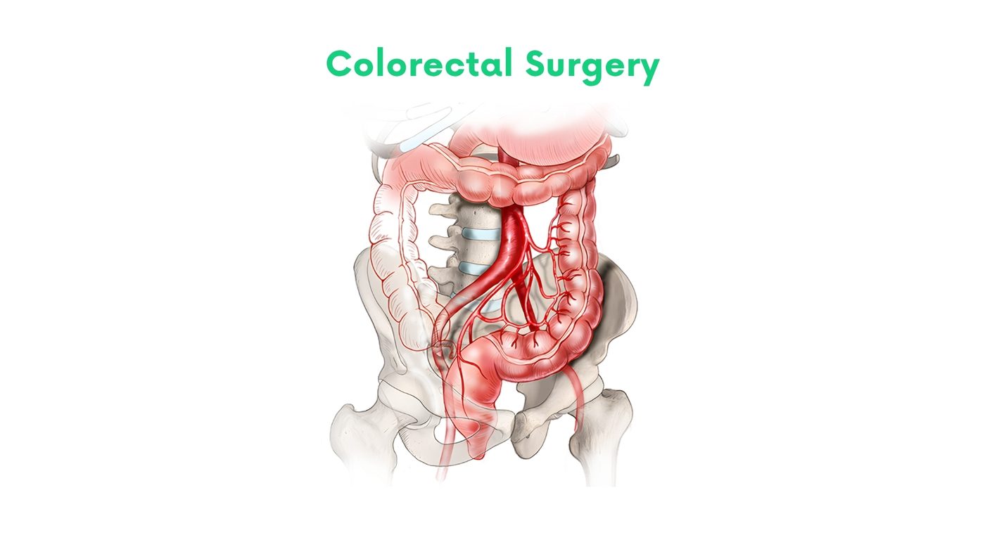 Laparoscopic colorectal surgery (hemicolectomy, sigmoidectomy) by Dr. Shehryar Niazi
