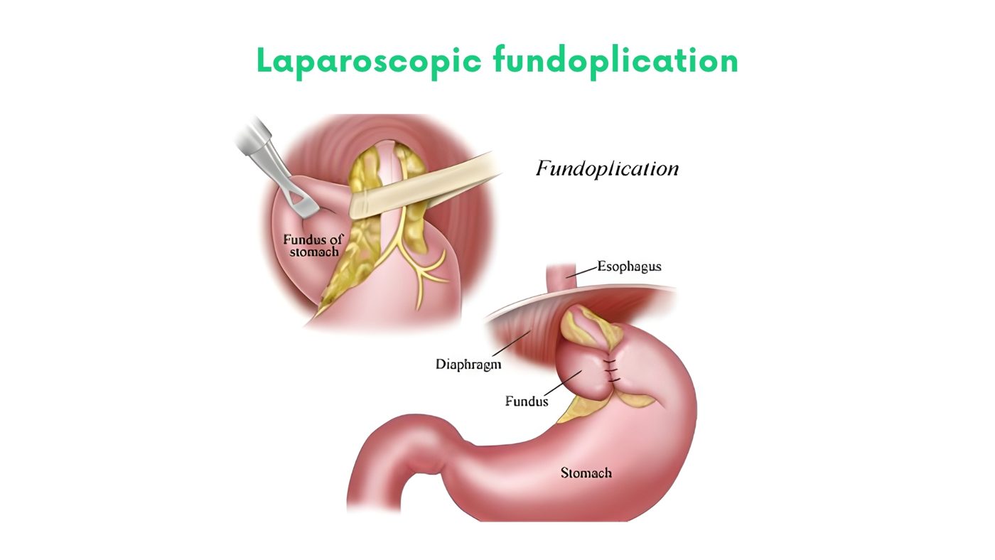 Laparoscopic fundoplication (GERD, hiatus hernia) by Dr. Shehryar Niazi