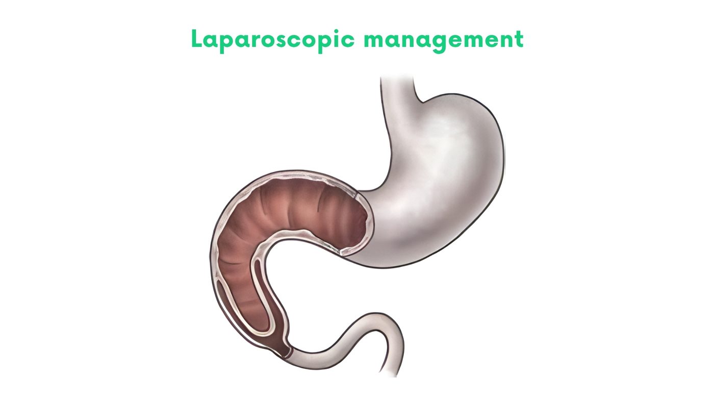 Laparoscopic management of intestinal obstruction by Dr. Shehryar Niazi