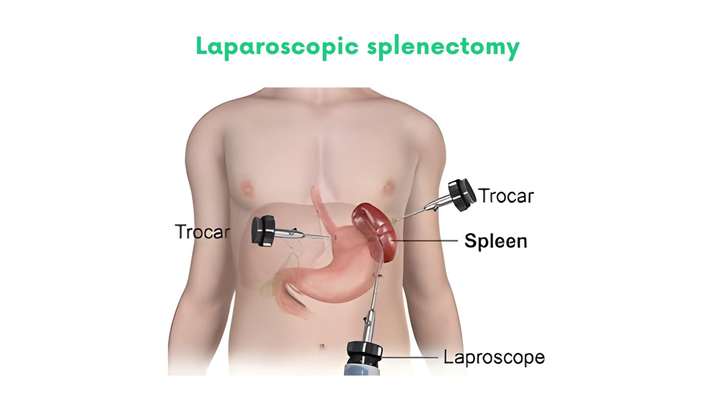 Laparoscopic splenectomy by Dr. Shehryar Niazi