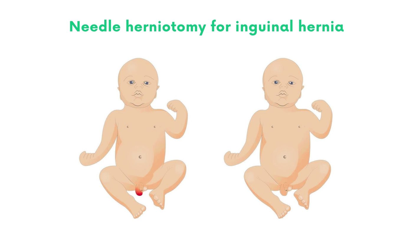 Needle herniotomy for inguinal hernia (children) by Dr. Shehryar Niazi