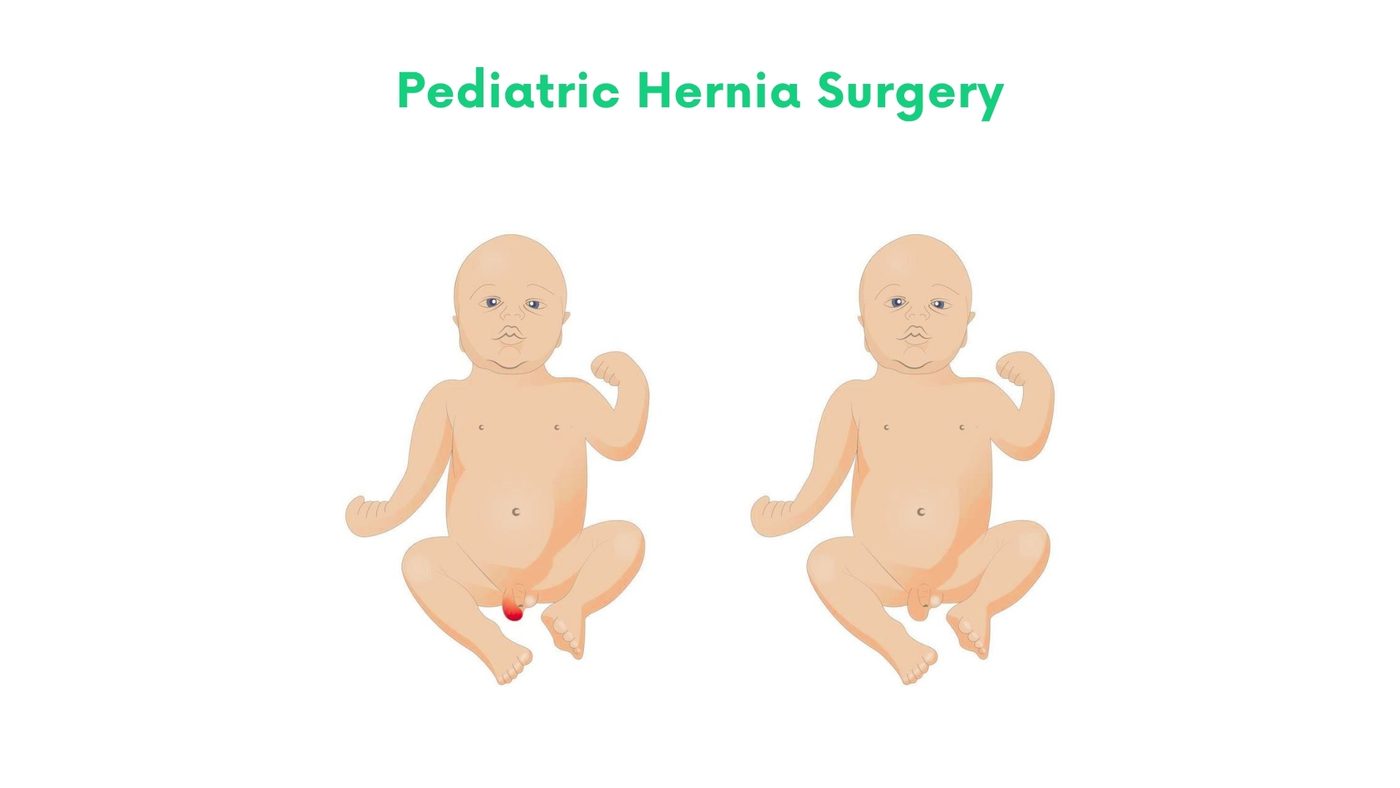 Pediatric Hernia Surgery by Dr. Shehryar Niazi