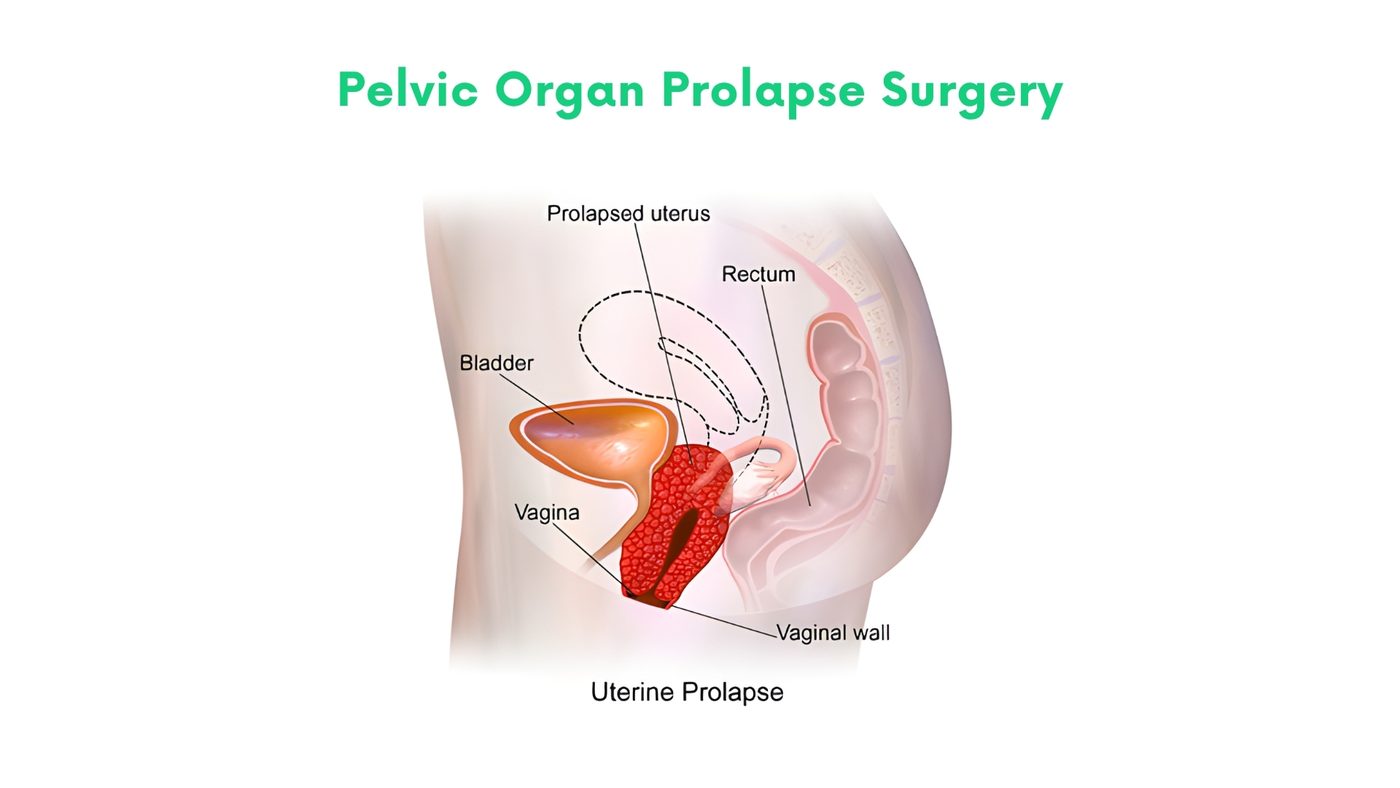 Pelvic Organ Prolapse Surgery by Dr. Shehryar Niazi