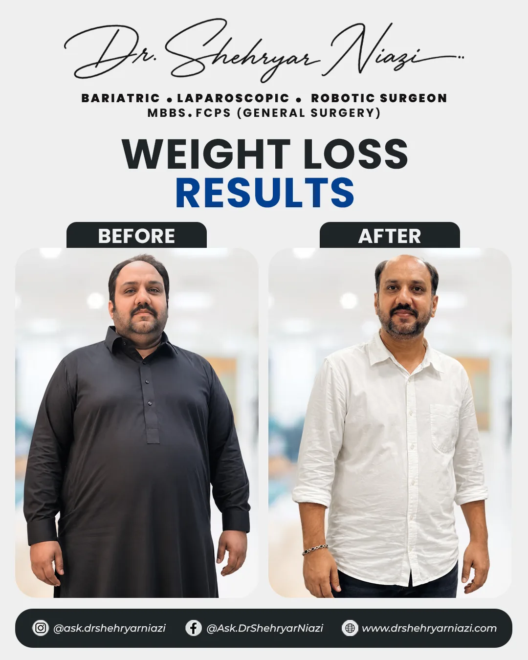 Before and after weight loss surgery result by Dr. Shehryar Niazi