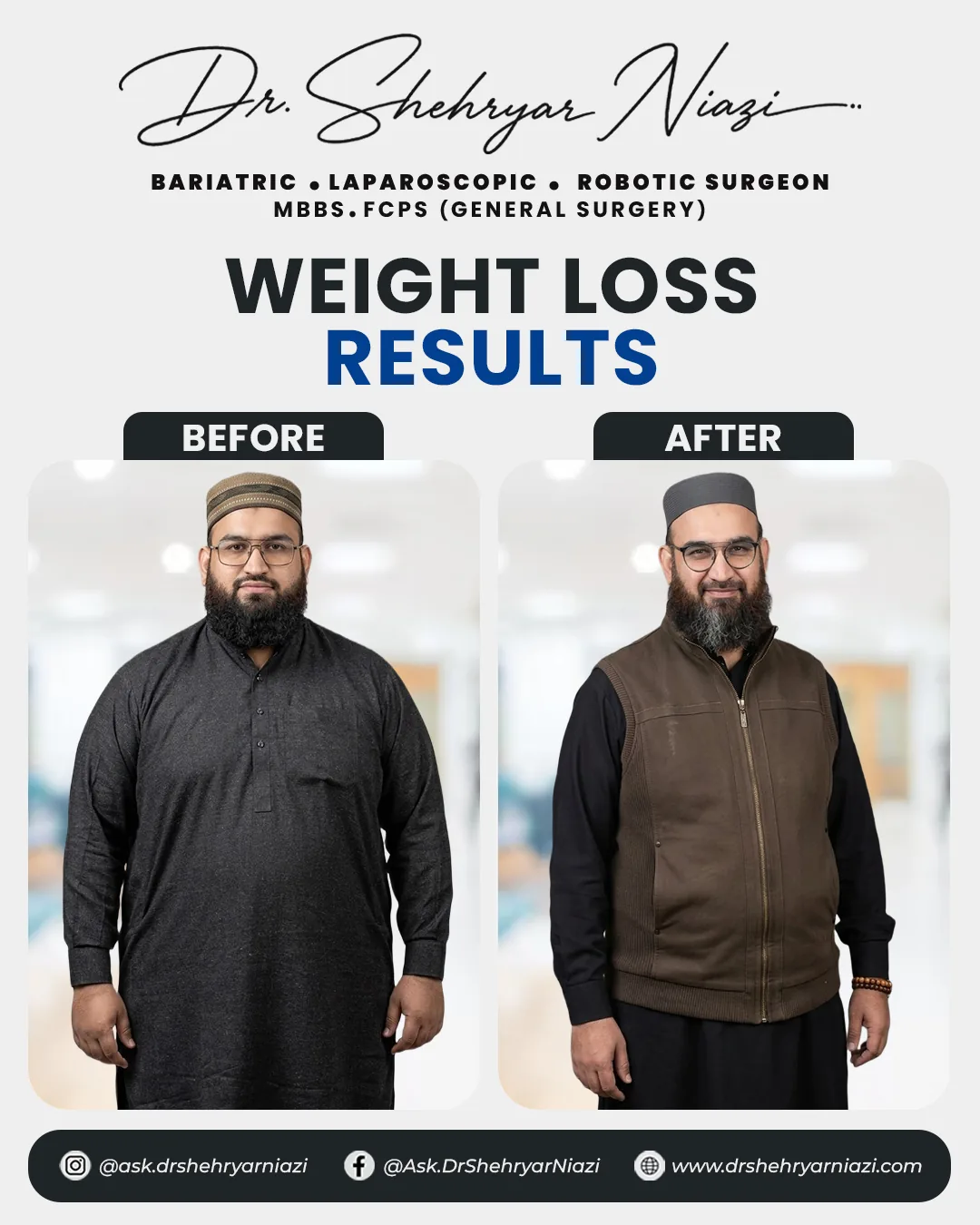 Weight loss surgery before and after result 10, bariatric patient of Dr. Shehryar Niazi