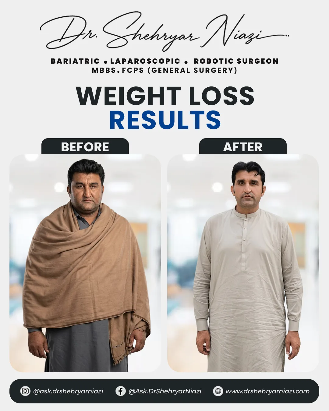 Weight loss surgery before and after result 6, bariatric patient of Dr. Shehryar Niazi