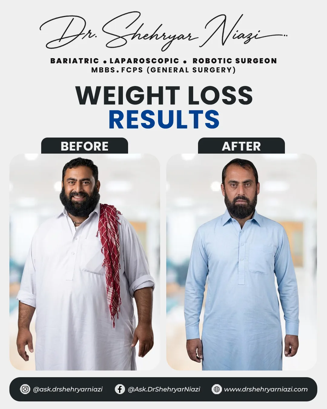 Weight loss surgery before and after result 7, bariatric patient of Dr. Shehryar Niazi