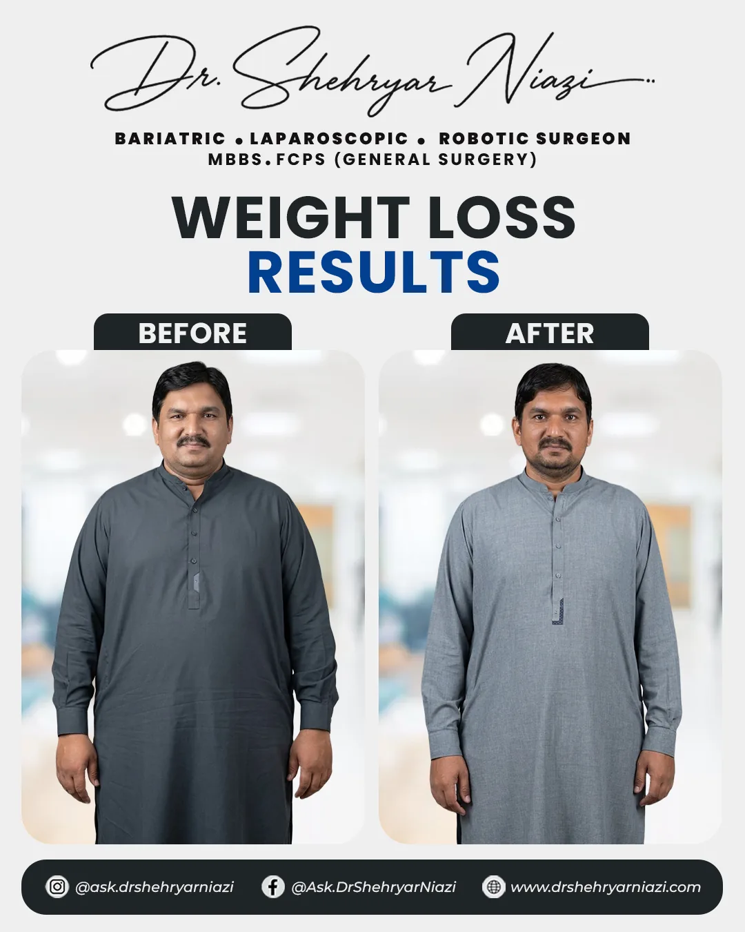Weight loss surgery before and after result 8, bariatric patient of Dr. Shehryar Niazi
