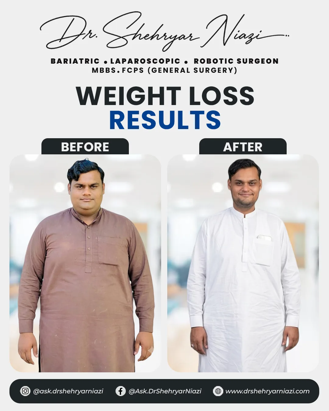 Weight loss surgery before and after result 9, bariatric patient of Dr. Shehryar Niazi