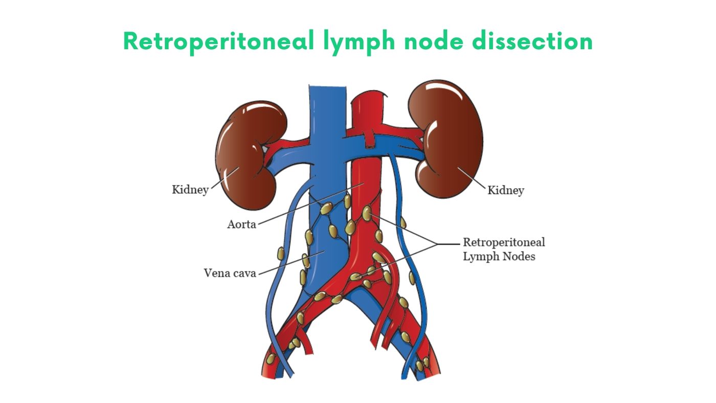 Retroperitoneal lymph node dissection (RPLND) by Dr. Shehryar Niazi