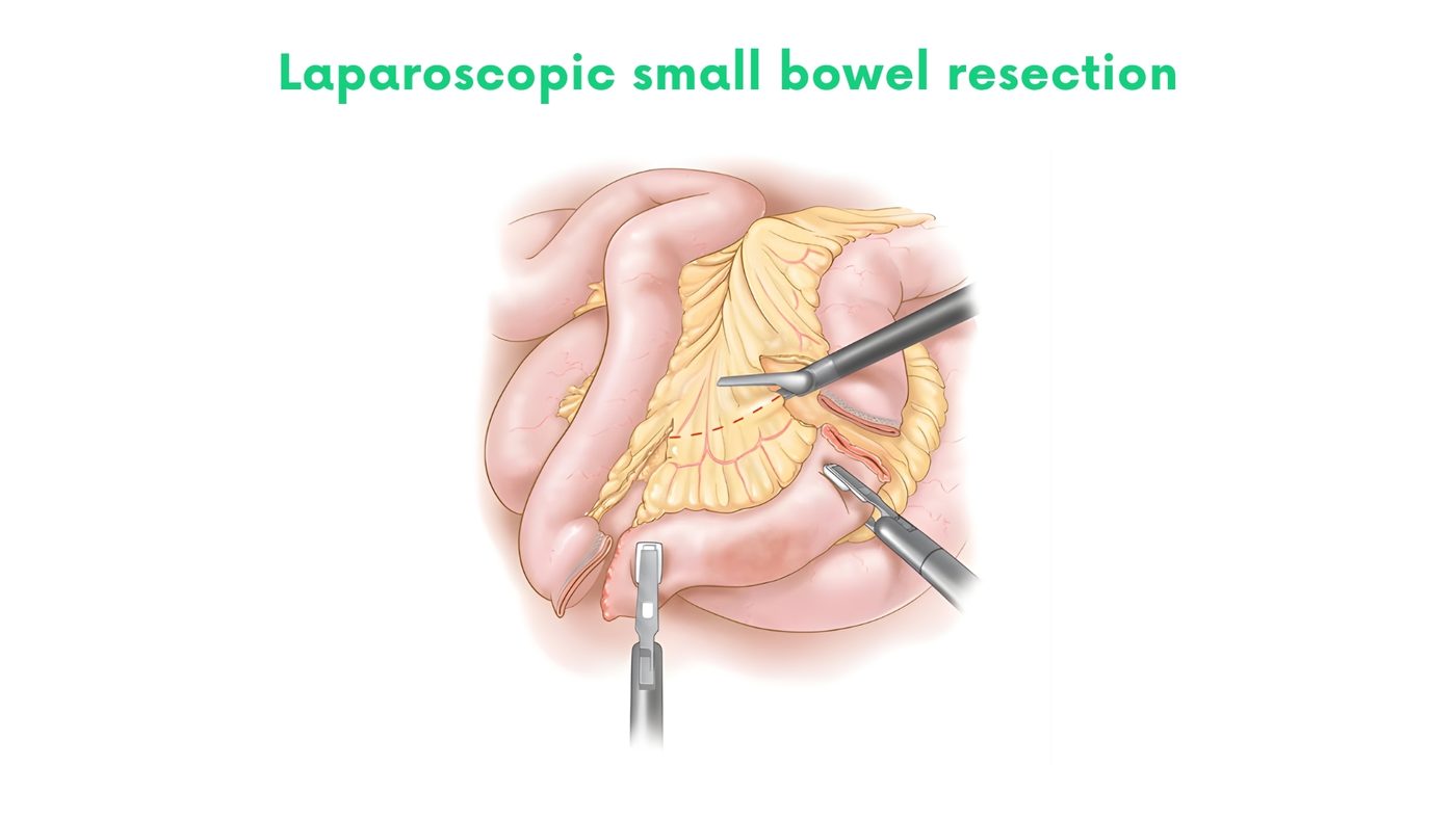 Laparoscopic small bowel resection and anastomosis by Dr. Shehryar Niazi