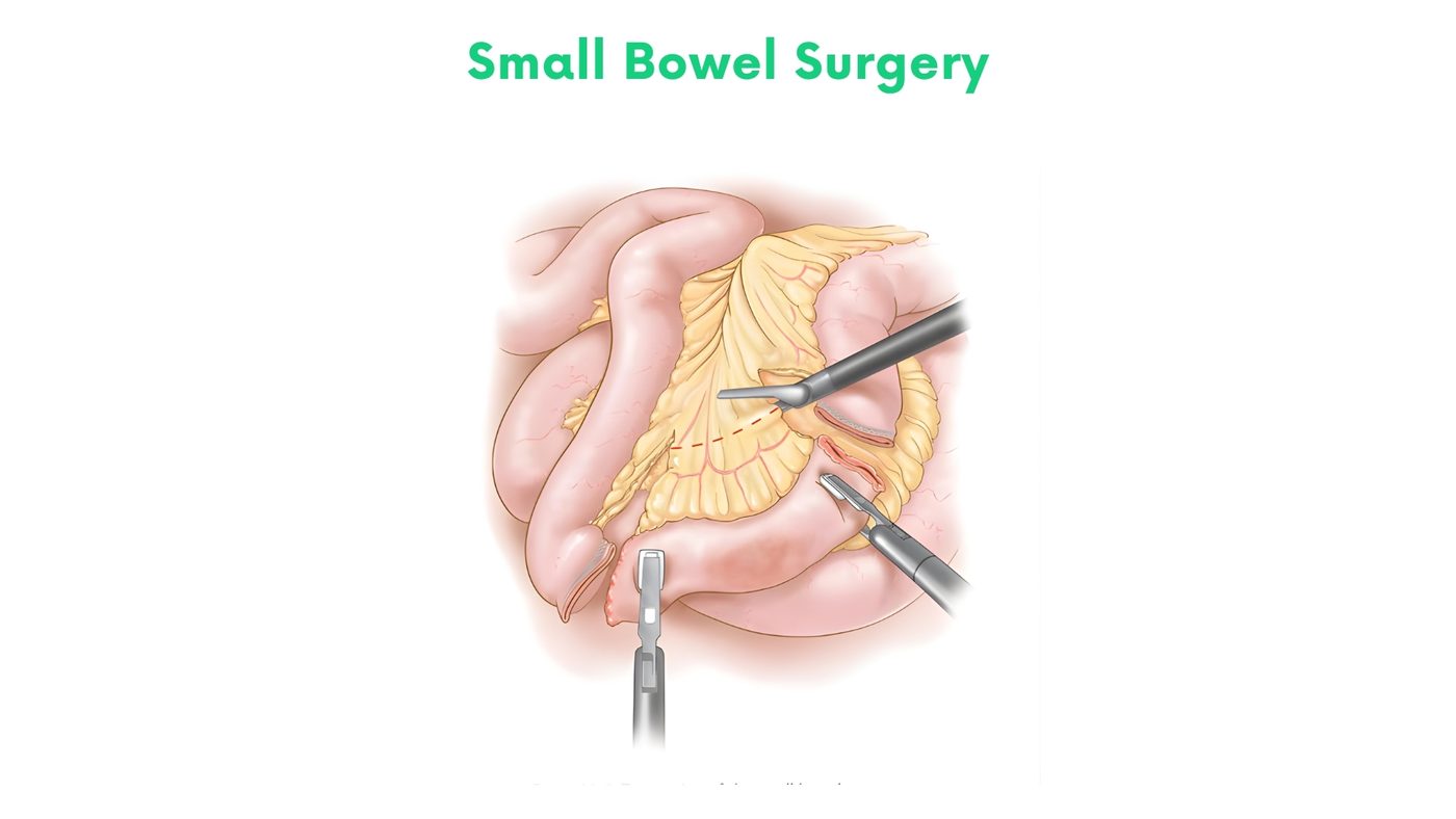 Small Bowel Surgery by Dr. Shehryar Niazi