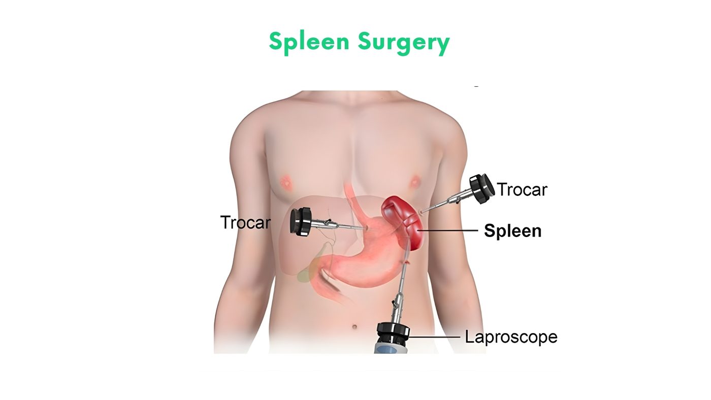 Spleen Surgery by Dr. Shehryar Niazi