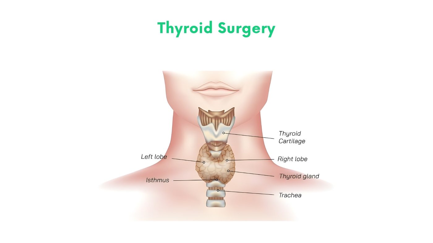 Thyroid Surgery by Dr. Shehryar Niazi