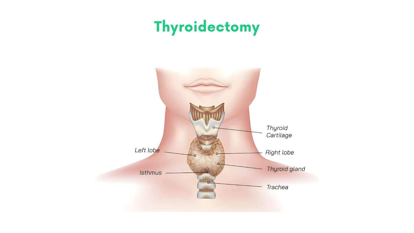 Thyroidectomy by Dr. Shehryar Niazi