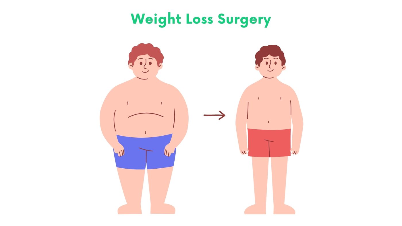 Weight Loss Surgery by Dr. Shehryar Niazi